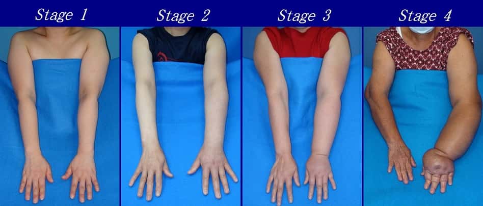 Upper limb lymphedema